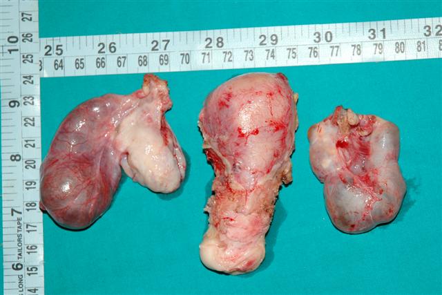 Bilateral tubo-ovarian masses with uterus